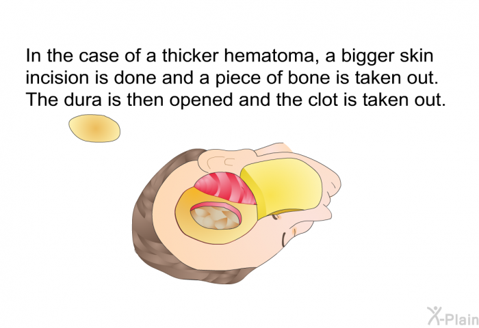In the case of a thicker hematoma, a bigger skin incision is done and a piece of bone is taken out. The dura is then opened and the clot is taken out.