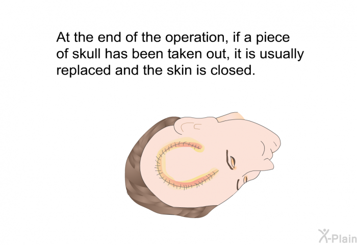 At the end of the operation, if a piece of skull has been taken out, it is usually replaced and the skin is closed.