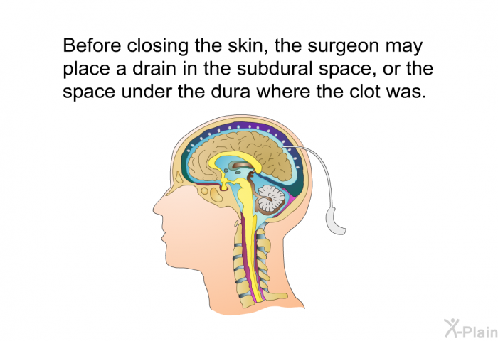 Before closing the skin, the surgeon may place a drain in the subdural space, or the space under the dura where the clot was.