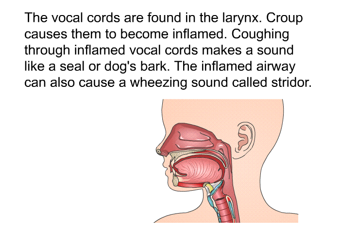 The vocal cords are found in the larynx. Croup causes them to become inflamed. Coughing through inflamed vocal cords makes a sound like a seal or dog's bark. The inflamed airway can also cause a wheezing sound called stridor.