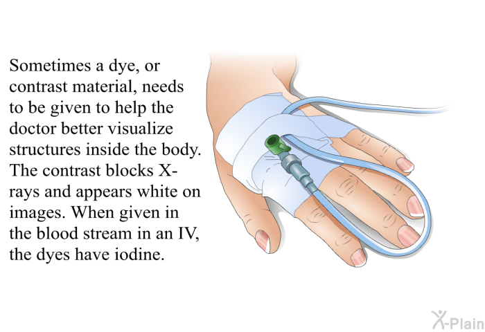 Sometimes a dye, or contrast material, needs to be given to help the doctor better visualize structures inside the body. The contrast blocks X-rays and appears white on images. When given in the blood stream in an IV, the dyes have iodine.