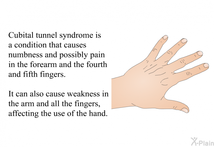 Cubital tunnel syndrome is a condition that causes numbness and possibly pain in the forearm and the fourth and fifth fingers. It can also cause weakness in the arm and all the fingers, affecting the use of the hand.