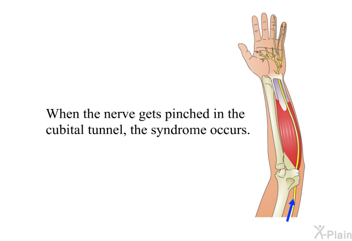 When the nerve gets pinched in the cubital tunnel, the syndrome occurs.