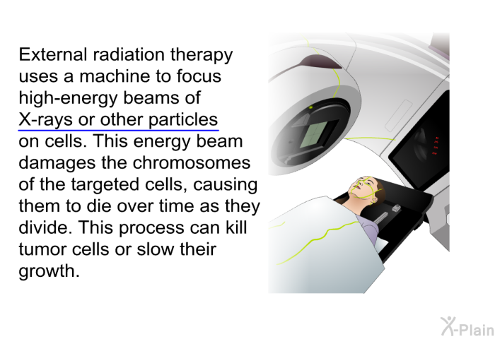 External radiation therapy uses a machine to focus high-energy beams of X-rays or other particles on cells. This energy beam damages the chromosomes of the targeted cells, causing them to die over time as they divide. This process can kill tumor cells or slow their growth.