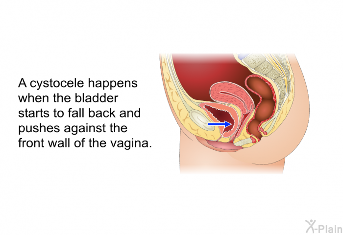 A cystocele happens when the bladder starts to fall back and pushes against the front wall of the vagina.