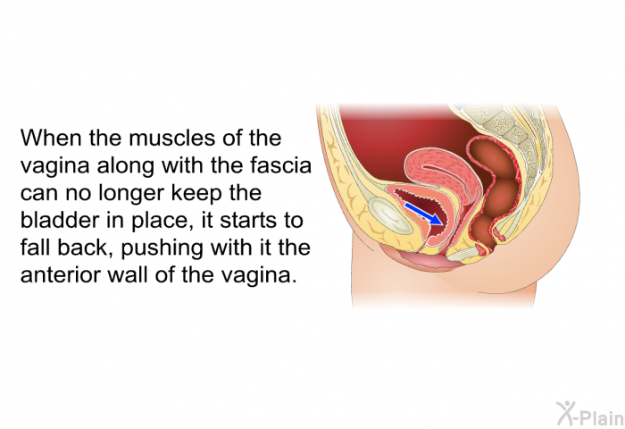 When the muscles of the vagina along with the fascia can no longer keep the bladder in place, it starts to fall back, pushing with it the anterior wall of the vagina.