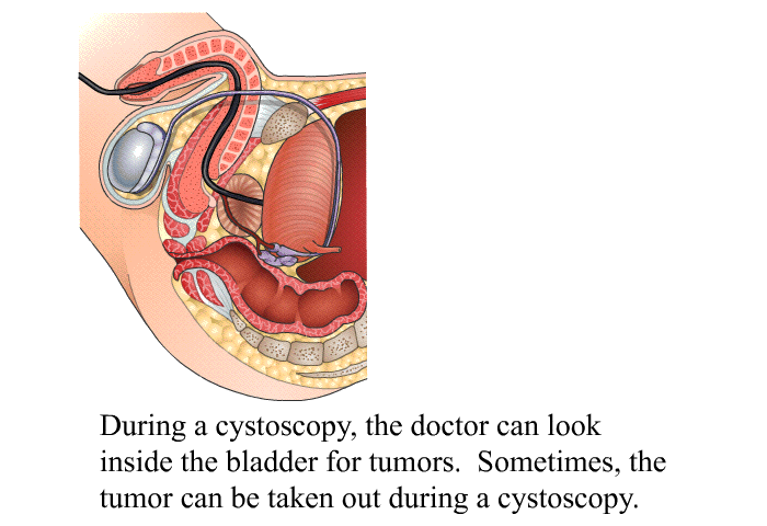 During a cystoscopy, the doctor can look inside the bladder for tumors. Sometimes, the tumor can be taken out during a cystoscopy.