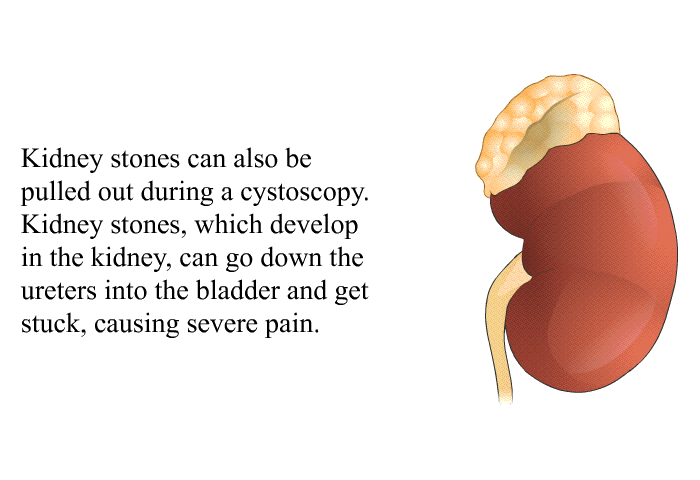 Kidney stones can also be pulled out during a cystoscopy. Kidney stones, which develop in the kidney, can go down the ureters into the bladder and get stuck, causing severe pain.