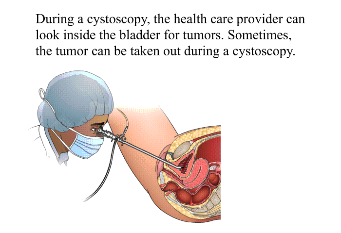 During a cystoscopy, the health care provider can look inside the bladder for tumors. Sometimes, the tumor can be taken out during a cystoscopy.