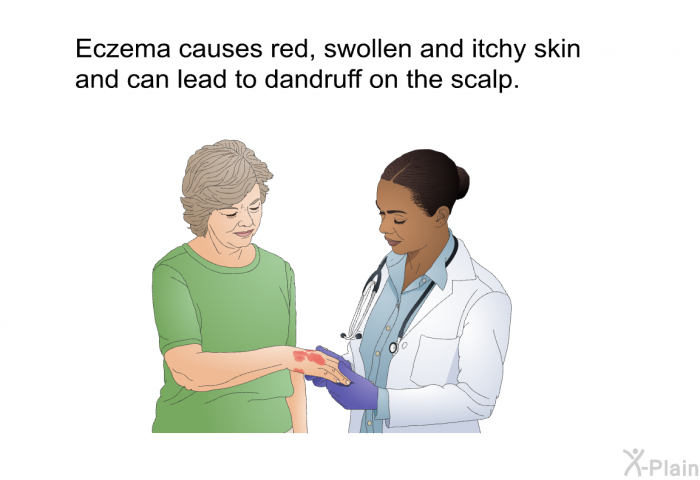 Eczema causes red, swollen and itchy skin and can lead to dandruff on the scalp.