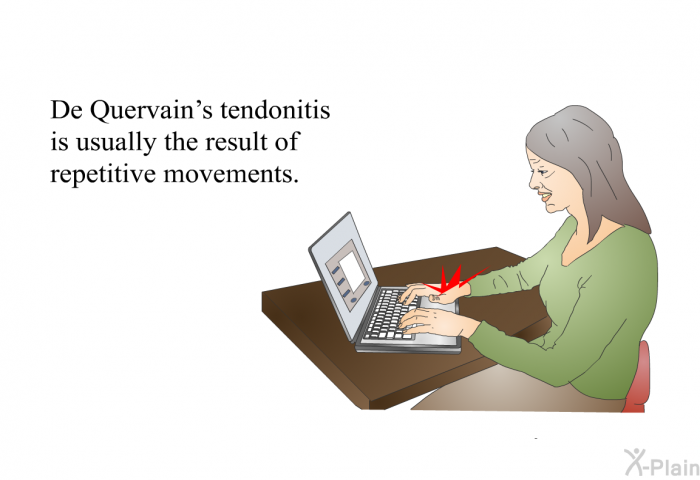 De Quervain's tendonitis is usually the result of repetitive movements.