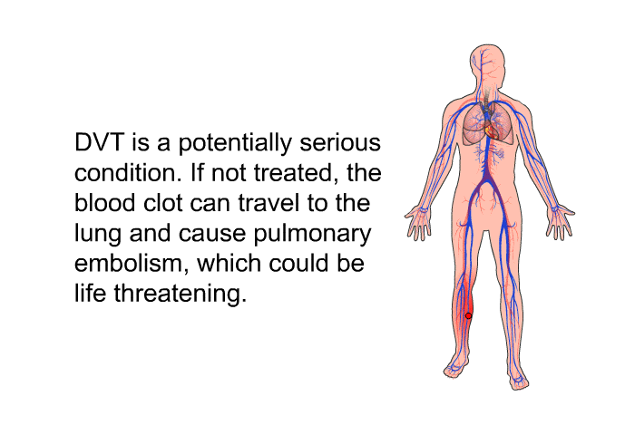 DVT is a potentially serious condition. If not treated, the blood clot can travel to the lung and cause pulmonary embolism, which could be life threatening.
