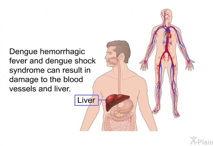 Dengue hemorrhagic fever and dengue shock syndrome can result in damage to the blood vessels and liver.