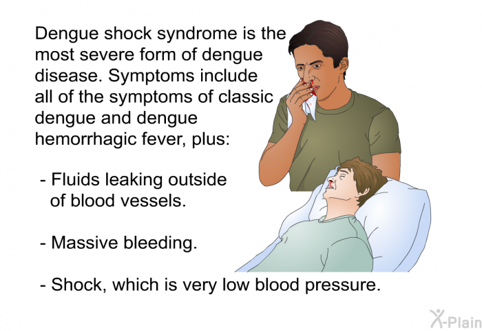 Dengue shock syndrome is the most severe form of dengue disease. Symptoms include all of the symptoms of classic dengue and dengue hemorrhagic fever, plus:  Fluids leaking outside of blood vessels. Massive bleeding. Shock, which is very low blood pressure.