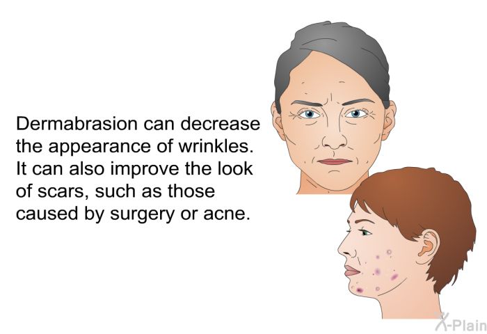 Dermabrasion can decrease the appearance of wrinkles. It can also improve the look of scars, such as those caused by surgery or acne.