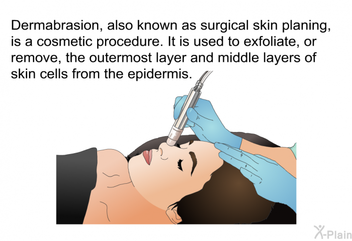 Dermabrasion, also known as surgical skin planing, is a cosmetic procedure. It is used to exfoliate, or remove, the outermost layer and middle layers of skin cells from the epidermis.