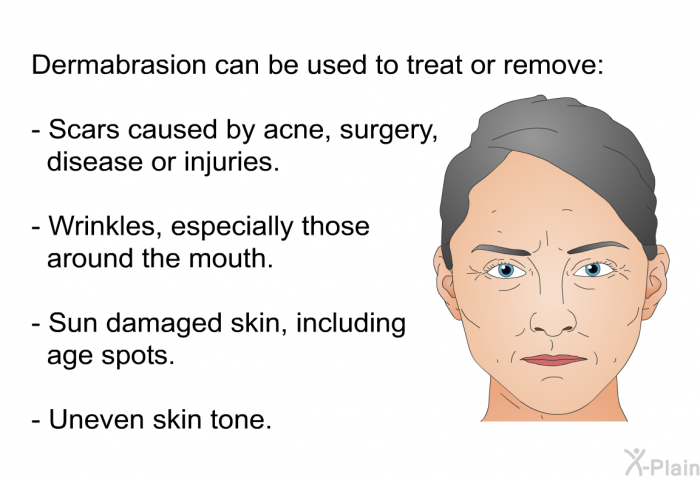 Dermabrasion can be used to treat or remove:  Scars caused by acne, surgery, disease or injuries. Wrinkles, especially those around the mouth. Sun damaged skin, including age spots. Uneven skin tone.