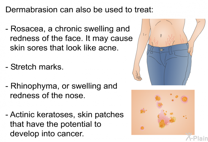 Dermabrasion can also be used to treat:  Rosacea, a chronic swelling and redness of the face. It may cause skin sores that look like acne. Stretch marks. Rhinophyma, or swelling and redness of the nose. Actinic keratoses, skin patches that have the potential to develop into cancer.