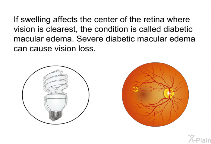 If swelling affects the center of the retina where vision is clearest, the condition is called diabetic macular edema. Severe diabetic macular edema can cause vision loss.
