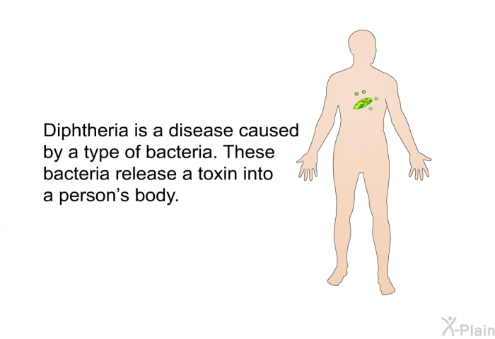 Diphtheria is a disease caused by a type of bacteria. These bacteria release a toxin into a person's body.