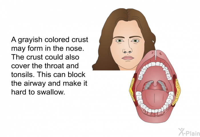 A grayish colored crust may form in the nose. The crust could also cover the throat and tonsils. This can block the airway and make it hard to swallow.