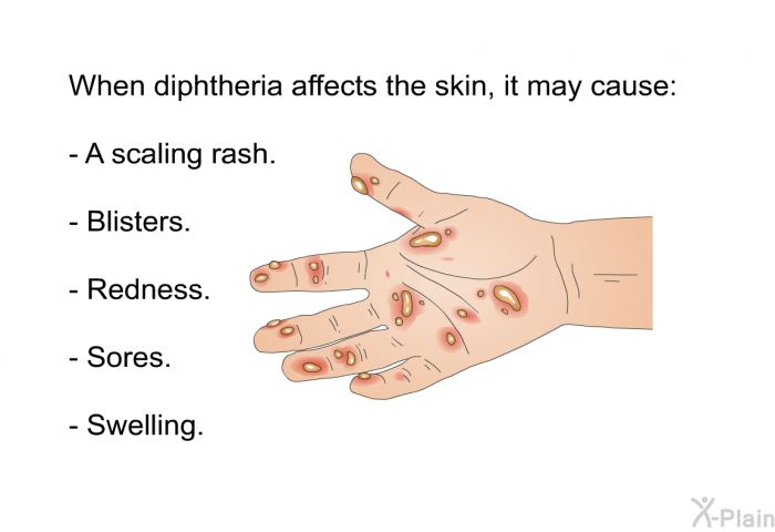 When diphtheria affects the skin, it may cause:  A scaling rash. Blisters. Redness. Sores. Swelling.