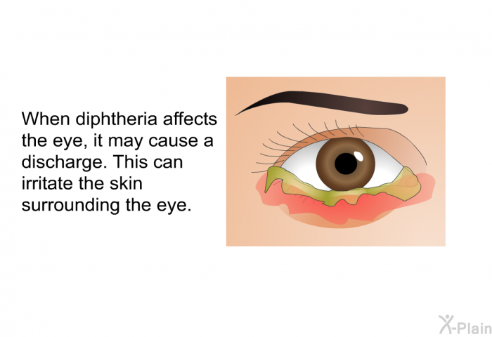 When diphtheria affects the eye, it may cause a discharge. This can irritate the skin surrounding the eye.