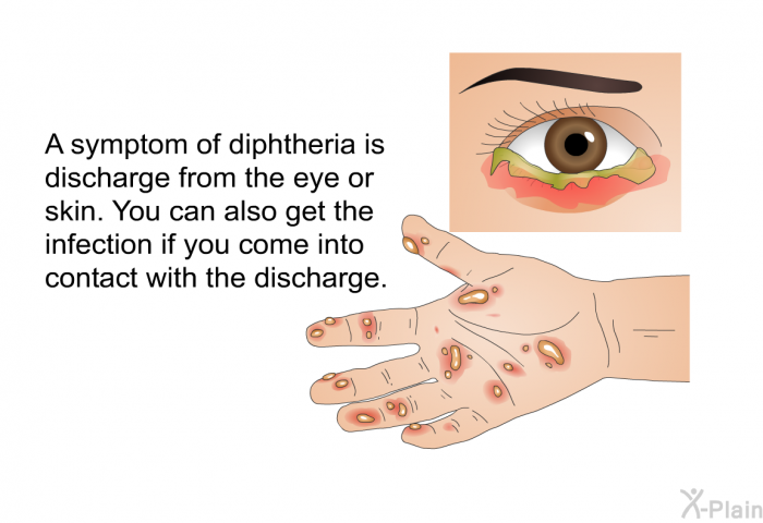 A symptom of diphtheria is discharge from the eye or skin. You can also get the infection if you come into contact with the discharge.