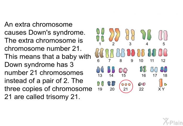 An extra chromosome causes Down's syndrome. The extra chromosome is chromosome number 21. This means that a baby with Down syndrome has 3 number 21 chromosomes instead of a pair of 2. The three copies of chromosome 21 are called trisomy 21.