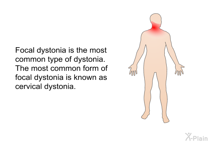 Focal dystonia is the most common type of dystonia. The most common form of focal dystonia is known as cervical dystonia.