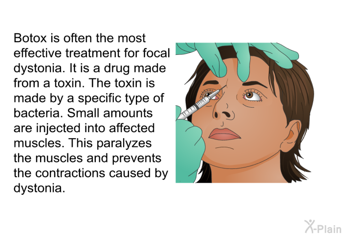 Botox is often the most effective treatment for focal dystonia. It is a drug made from a toxin. The toxin is made by a specific type of bacteria. Small amounts are injected into affected muscles. This paralyzes the muscles and prevents the contractions caused by dystonia.