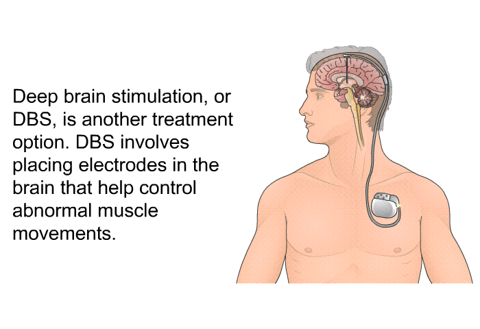 Deep brain stimulation, or DBS, is another treatment option. DBS involves placing electrodes in the brain that help control abnormal muscle movements.