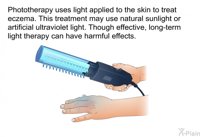 Phototherapy uses light applied to the skin to treat eczema. This treatment may use natural sunlight or artificial ultraviolet light. Though effective, long-term light therapy can have harmful effects.