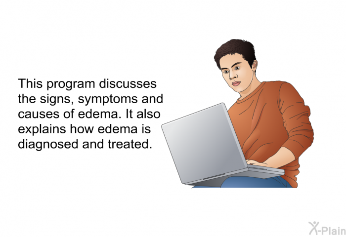 This health information discusses the signs, symptoms and causes of edema. It also explains how edema is diagnosed and treated.