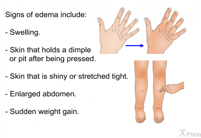 Signs of edema include:  Swelling. Skin that holds a dimple or pit after being pressed. Skin that is shiny or stretched tight. Enlarged abdomen. Sudden weight gain.