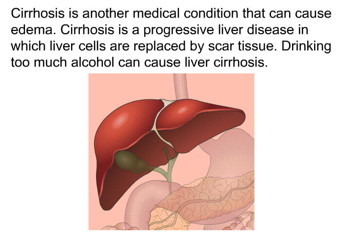 Cirrhosis is another medical condition that can cause edema. Cirrhosis is a progressive liver disease in which liver cells are replaced by scar tissue. Drinking too much alcohol can cause liver cirrhosis.