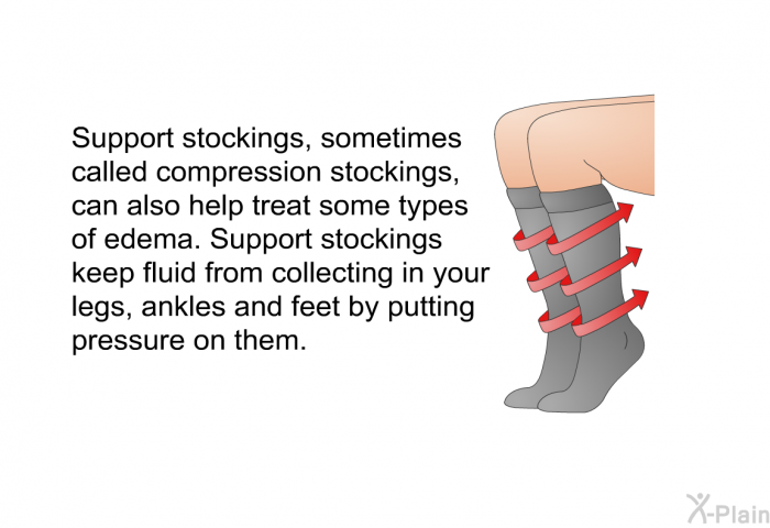 Support stockings, sometimes called compression stockings, can also help treat some types of edema. Support stockings keep fluid from collecting in your legs, ankles and feet by putting pressure on them.