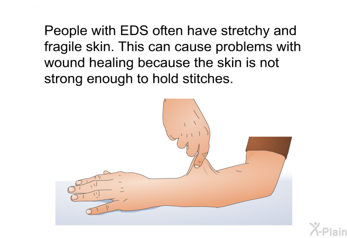People with EDS often have stretchy and fragile skin. This can cause problems with wound healing because the skin is not strong enough to hold stitches.
