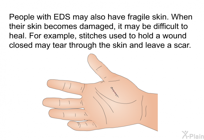 People with EDS may also have fragile skin. When their skin becomes damaged, it may be difficult to heal. For example, stitches used to hold a wound closed may tear through the skin and leave a scar.