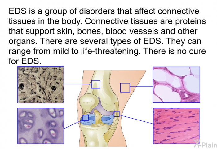 EDS is a group of disorders that affect connective tissues in the body. Connective tissues are proteins that support skin, bones, blood vessels and other organs. There are several types of EDS. They can range from mild to life-threatening. There is no cure for EDS.