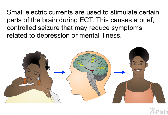 Small electric currents are used to stimulate certain parts of the brain during ECT. This causes a brief, controlled seizure that may reduce symptoms related to depression or mental illness.