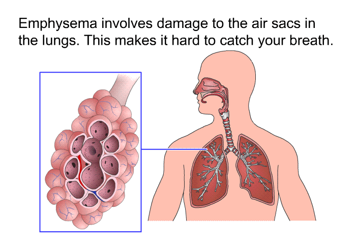 Emphysema involves damage to the air sacs in the lungs. This makes it hard to catch your breath.