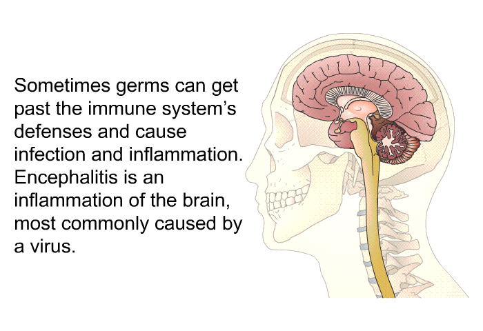 Sometimes germs can get past the immune system's defenses and cause infection and inflammation. Encephalitis is an inflammation of the brain, most commonly caused by a virus.