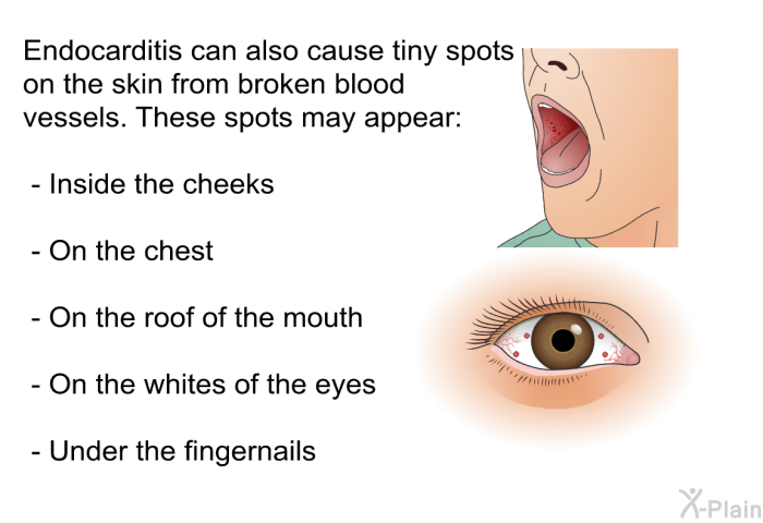 Endocarditis can also cause tiny spots on the skin from broken blood vessels. These spots may appear:  Inside the cheeks On the chest On the roof of the mouth On the whites of the eyes Under the fingernails