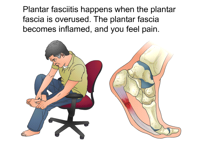 Plantar fasciitis happens when the plantar fascia is overused. The plantar fascia becomes inflamed, and you feel pain.