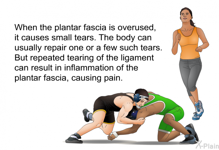 When the plantar fascia is overused, it causes small tears. The body can usually repair one or a few such tears. But repeated tearing of the ligament can result in inflammation of the plantar fascia, causing pain.