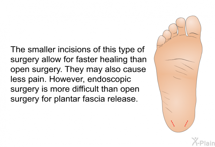 The smaller incisions of this type of surgery allow for faster healing than open surgery. They may also cause less pain. However, endoscopic surgery is more difficult than open surgery for plantar fascia release.