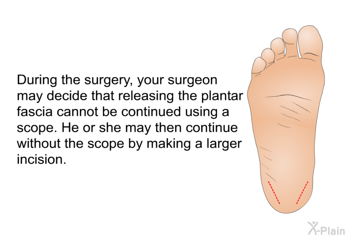 During the surgery, your surgeon may decide that releasing the plantar fascia cannot be continued using a scope. He or she may then continue without the scope by making a larger incision.