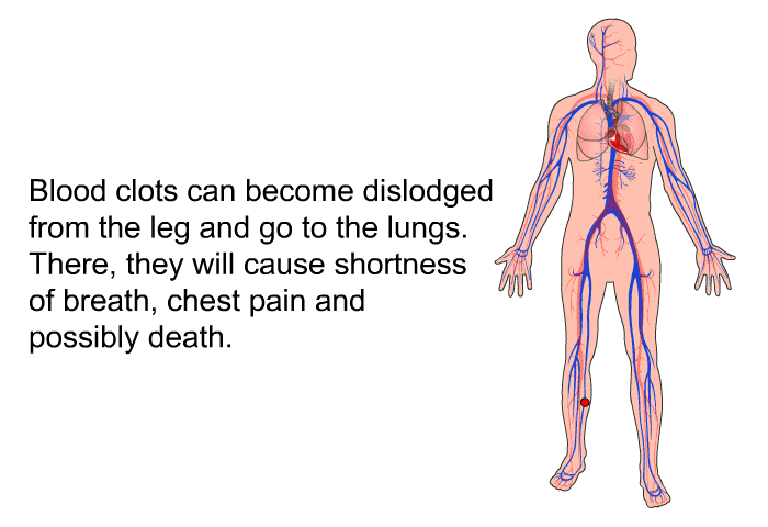 Blood clots can become dislodged from the leg and go to the lungs. There, they will cause shortness of breath, chest pain and possibly death.