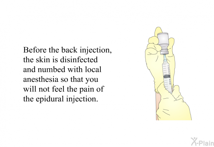 Before the back injection, the skin is disinfected and numbed with local anesthesia so that you will not feel the pain of the epidural injection.